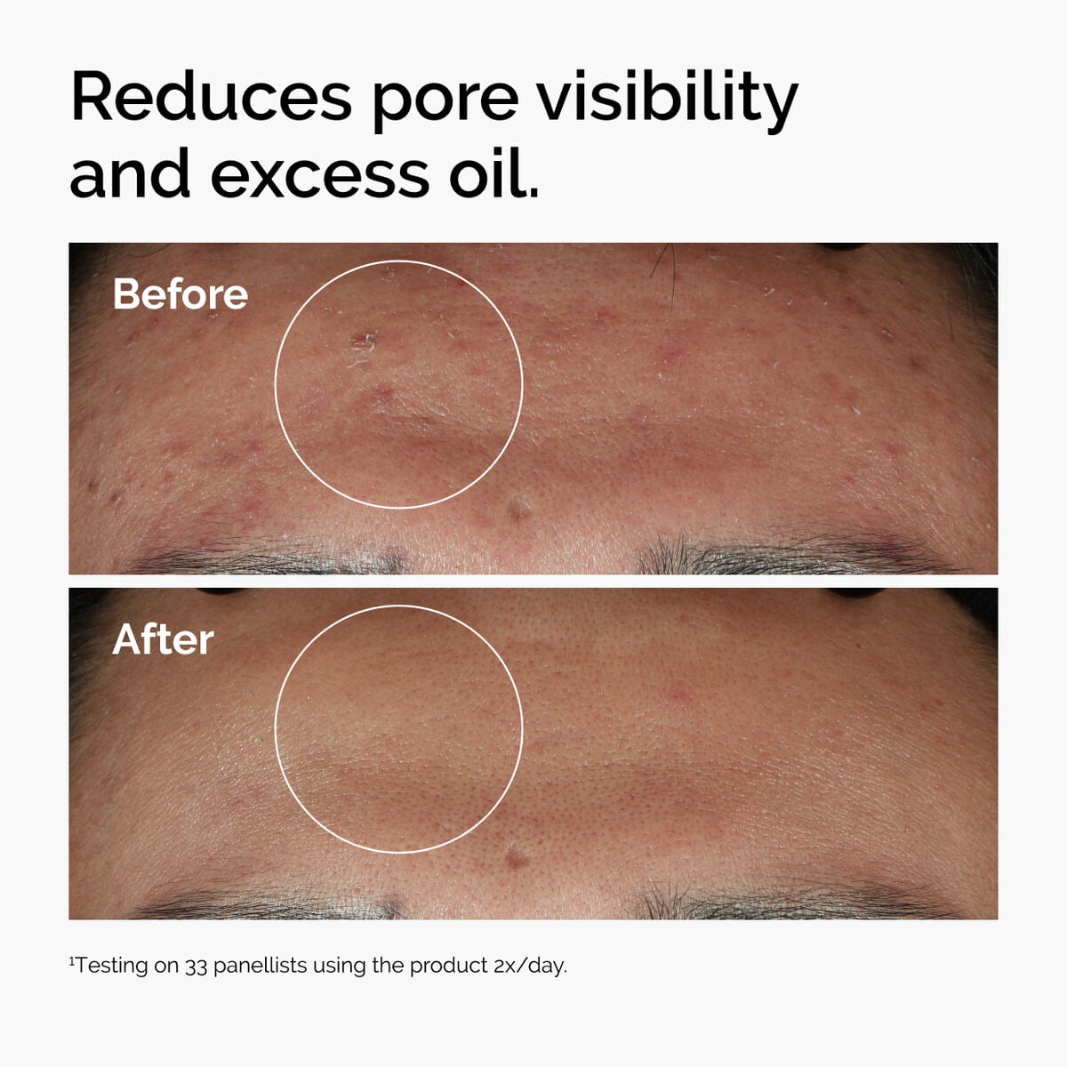 niacinamide-10-zinc-1-z9 ord-niacinamide-zinc-blemish-serum-before-after-pores.jpg
