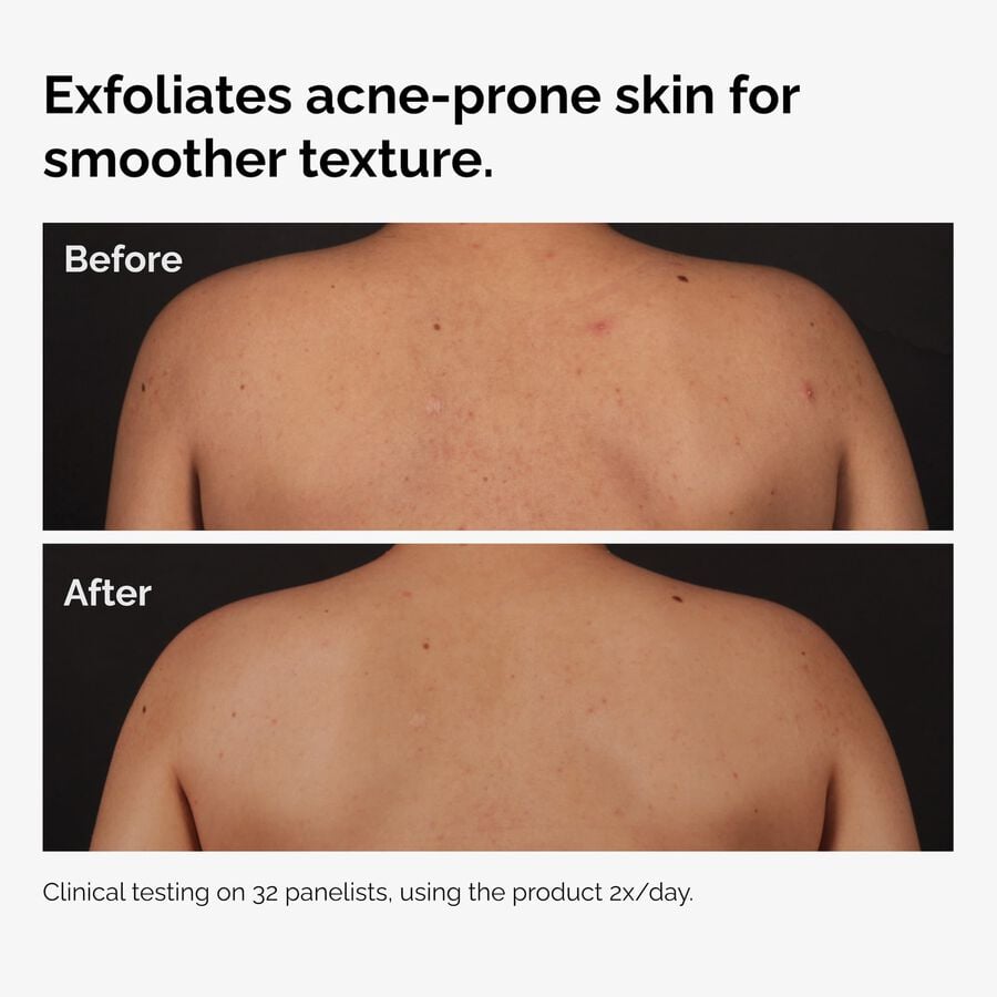 the-body-care-collection-d0 ord-salicylic-acid-body-serum-before-after-graphic-NA.jpg